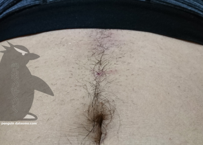 ケノンで陰毛脱毛