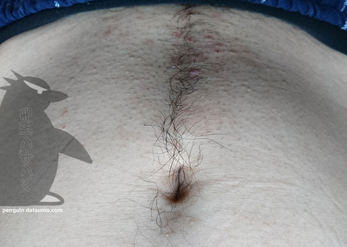 ケノンで下腹部を脱毛