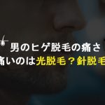 【男のヒゲ脱毛の痛さ】ニードルが1番痛かった泣【我慢できる？】