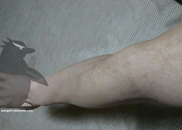 ケノンで腕脱毛6回目