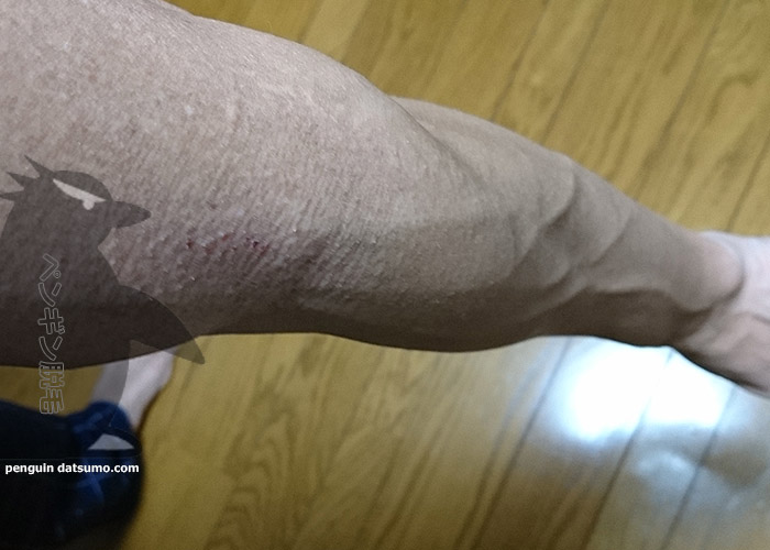 腕脱毛7回目の写真