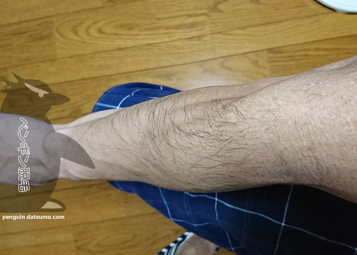 腕脱毛7回目前の写真