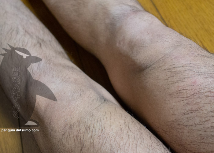 2回目照射から30日